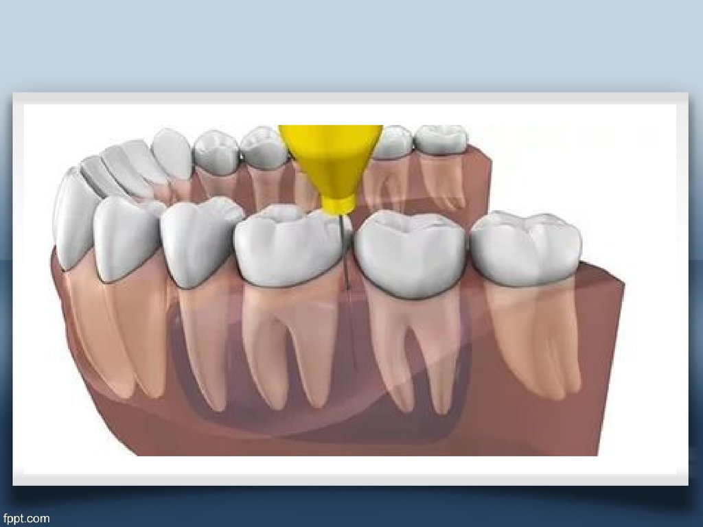 Зуб прошел. Внутрикостная спонгиозная анестезия. Внутрикостная анестезия в стоматологии. Внутрикостная инфильтрационная анестезия. Внутри котсная анестезия в стоматологии.