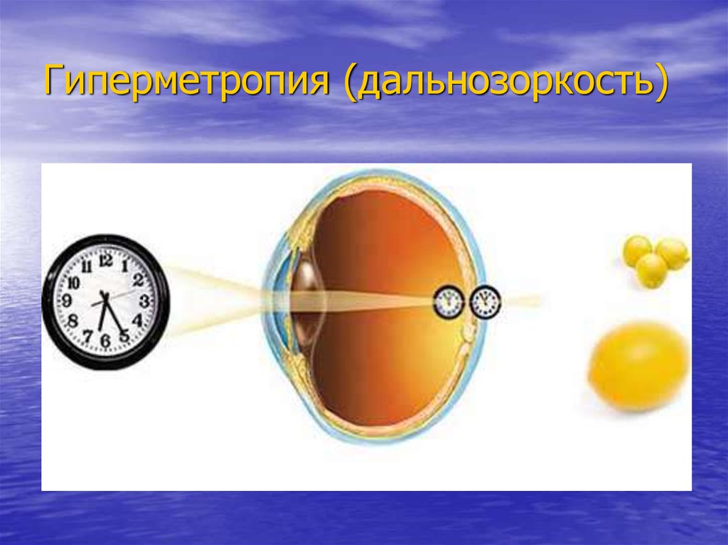 Гиперметропия степени. Дальнозоркость слабой степени. Дальнозоркость средней степени. Дальнозоркость (гиперметропия).