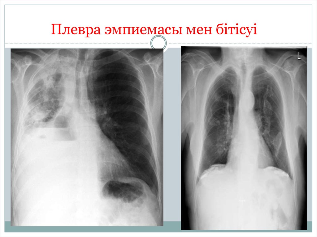 Пиоторакс это. Хроническая эмпиема плевры рентген. Тотальная эмпиема плевры рентген. Эмпиема легкого рентген. Эмпиема плевры рентген кт.