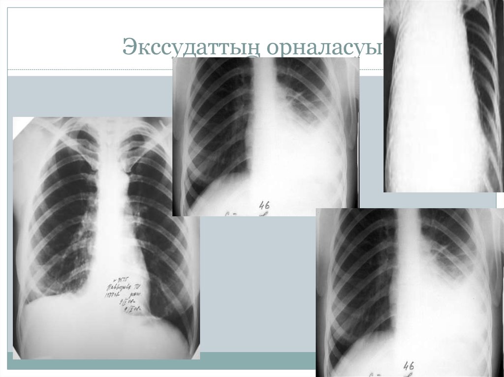 Презентация на тему плевриты