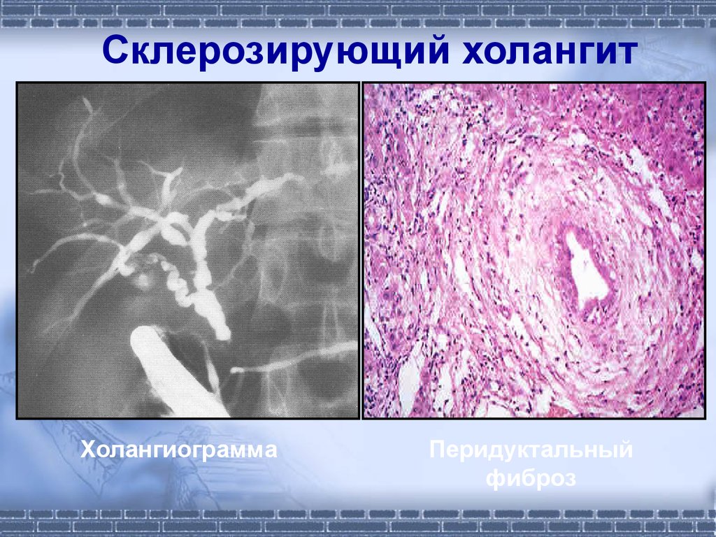 Склерозированный холангит. Первичный склерозирующий холангит УЗИ. Первичный склерозирующий холангит--ПСХ. Первичный склерозирующий холангит мрт. Первичный склерозирующий холангит кт.