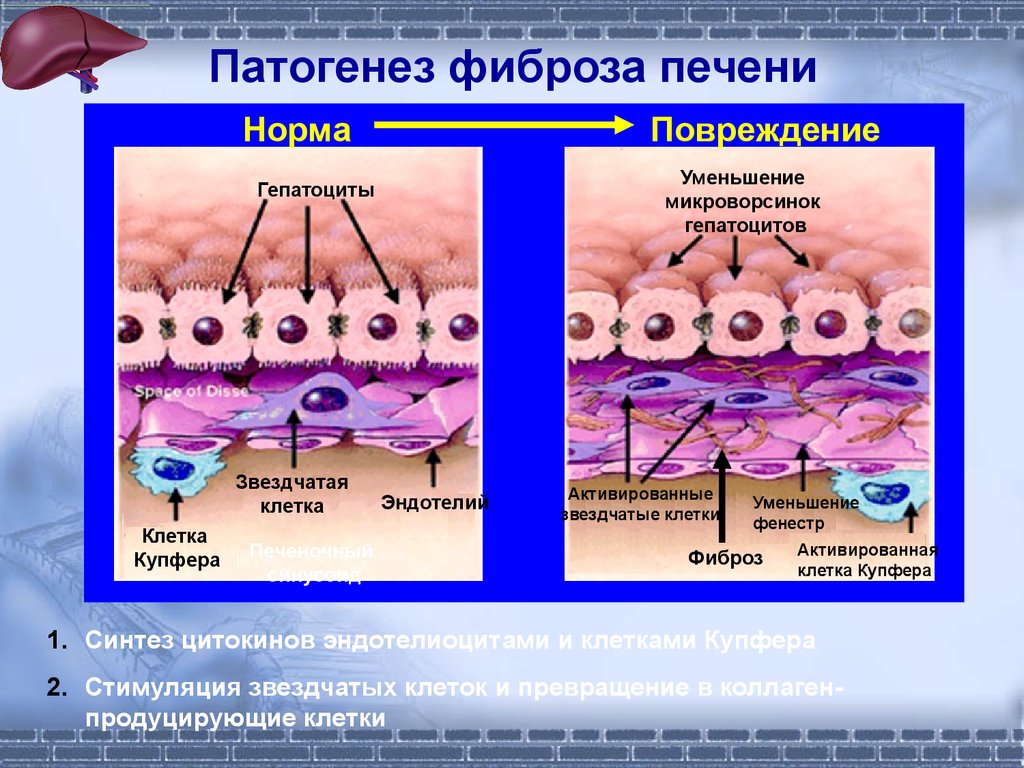 Повреждение клеток печени. Звездчатые эндотелиоциты печени. Купферовские клетки функции. Купферовские клетки печени выполняют функцию. Патогенез фиброза.