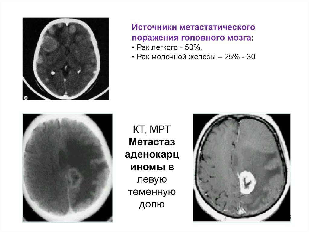Рак молочной железы метастазы в легких. Опухоли и метастазы головного мозга на кт. Метастатические опухоли головного мозга. Метастатическое поражение головного мозга.
