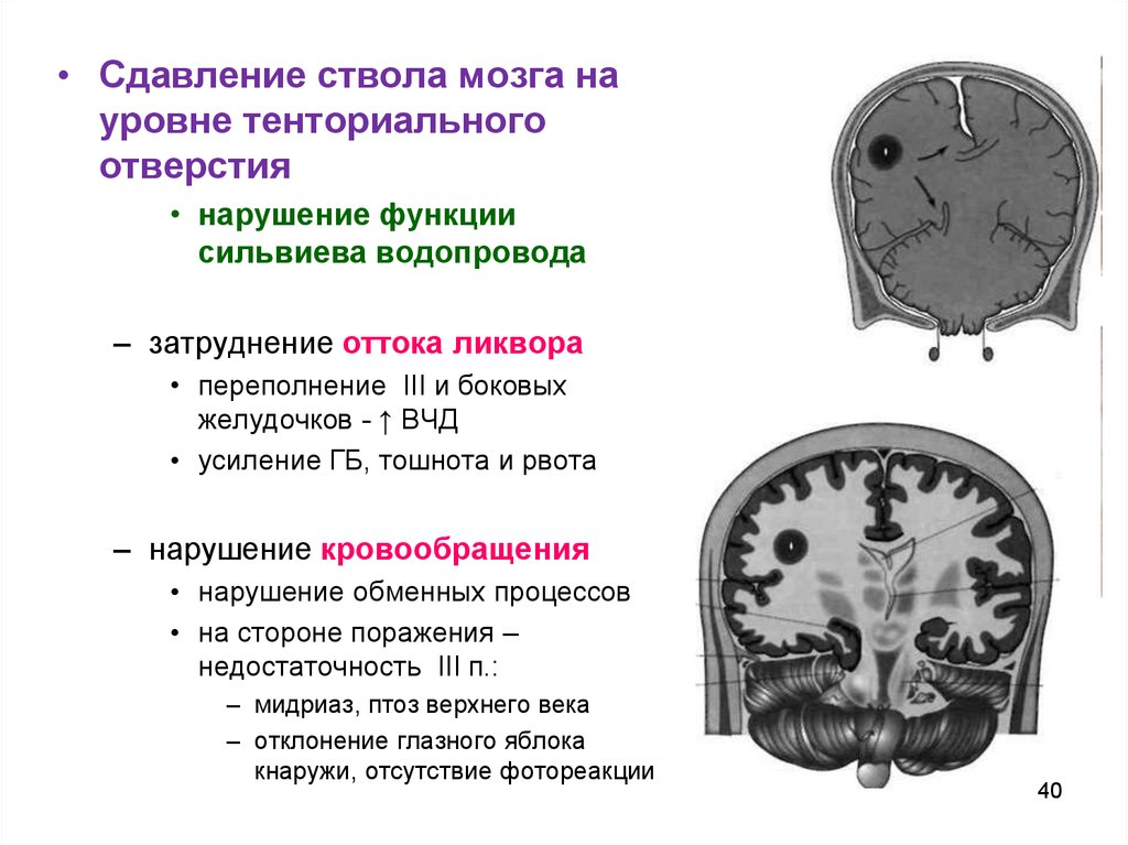 Сдавление мозга. Сдавление ствола головного мозга. Сдавление сильвиева водопровода. Повреждение ствола мозга. Компрессия ствола головного мозга.