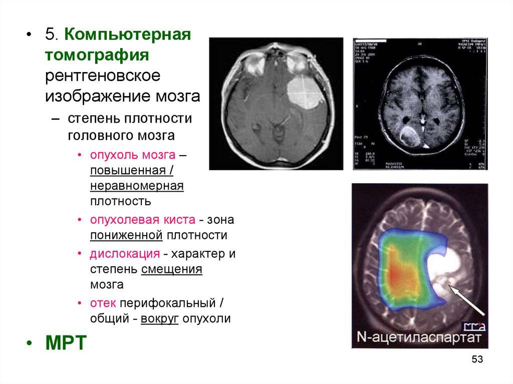 Рак мозга сколько стадий. Плотность злокачественной опухоли на кт. Глиома головного мозга кт. Перифокальный отек головного мозга на кт. Очаг пониженной плотности в головном мозге на кт.