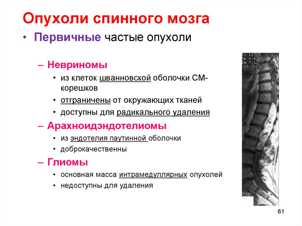 Опухоли мозга клиника. Диагностические критерии опухоли спинного мозга. Первичные опухоли спинного мозга классификация. Стадии развития клинических симптомов опухолей спинного мозга. Опухоли спинного мозга по гистологии классификация.