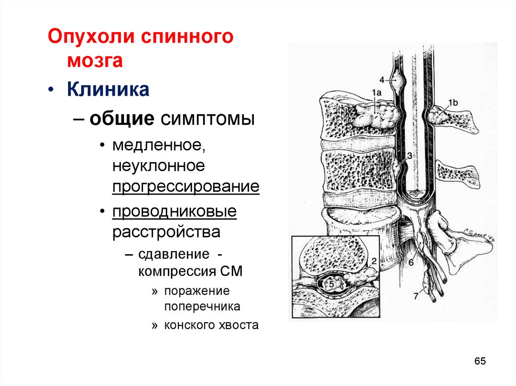 Опухоли мозга клиника. Экстрамедуллярная опухоль спинного мозга клиника. Стадии развития клинических симптомов опухолей спинного мозга. Опухоль конуса спинного мозга клиника. УЗИ признаки опухолей спинного мозга.