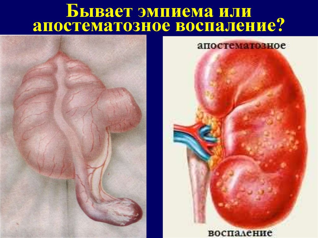 Бывает эмпиема или апостематозное воспаление?