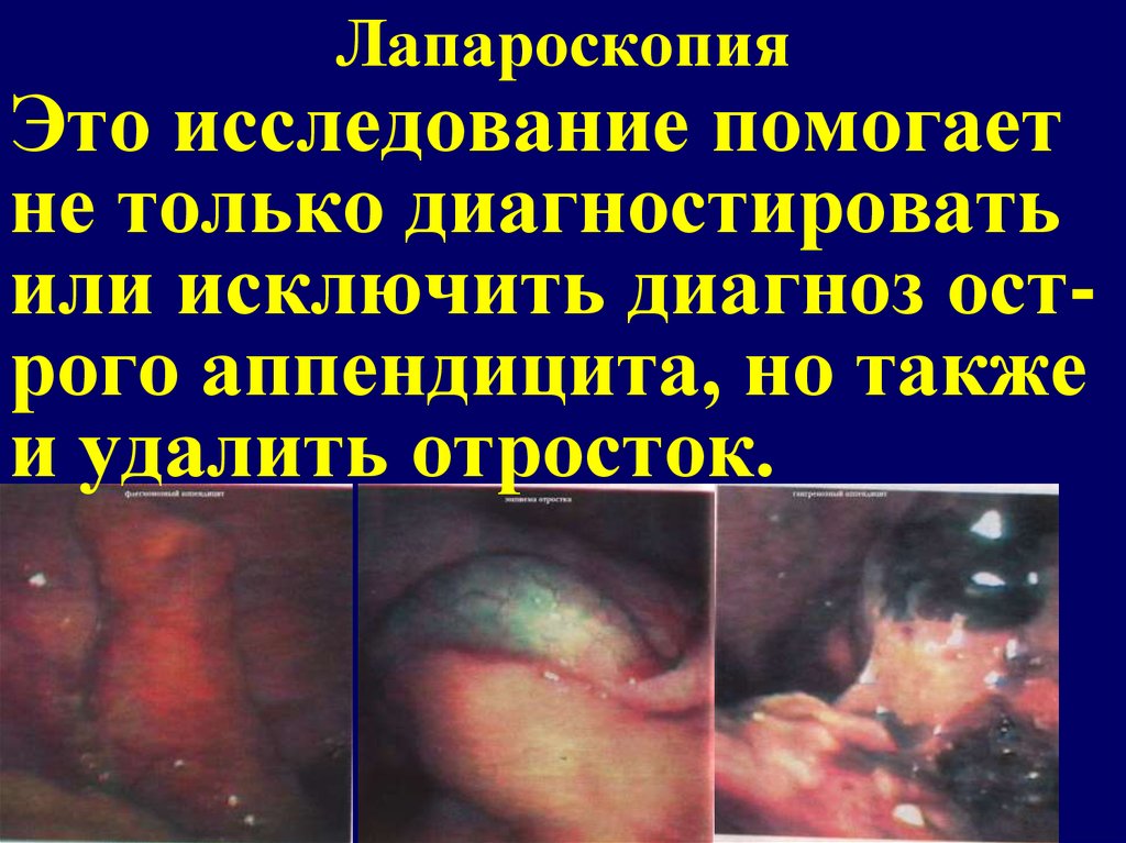 Лапароскопия