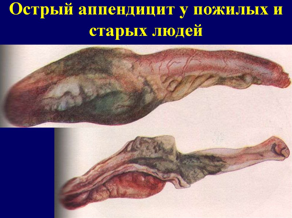 Острый аппендицит у пожилых и старых людей