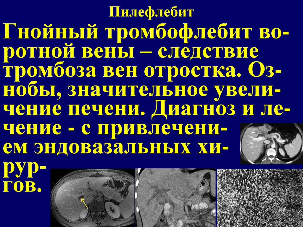 Пилефлебит причины развития патогенез клиническая картина методы диагностики и лечения