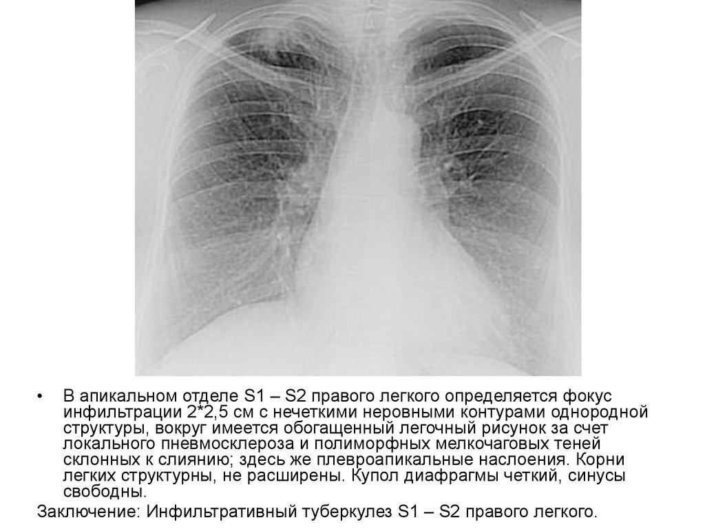 Легочный рисунок усилен в базальных отделах