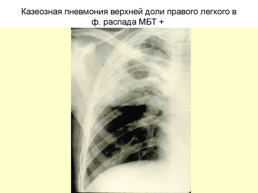 Пневмония верхней доли легкого. Казеозная пневмония туберкулез рентген. Ацинозная казеозная пневмония. Казеозная пневмония рентгенограмма. Казеозная пневмония диссеминированный туберкулез.