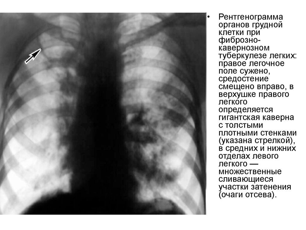 Изменения в верхней доле легкого. Рентгенография грудной клетки при инфильтративный туберкулез. Рентгенография грудной клетки при инфильтрация туберкулез. Кавернозный туберкулез каверна. Каверна туберкулез рентген.