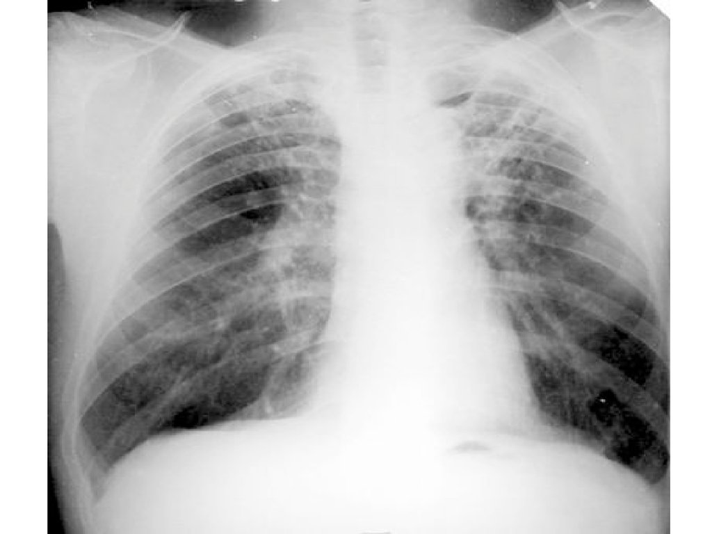 Прогрессирование туберкулеза. Рентген туберкулез туберкулема. Вторичный туберкулез рентгенограмма. Туберкулёз рентгенограмма. Рентген легких туберкулез снимки.