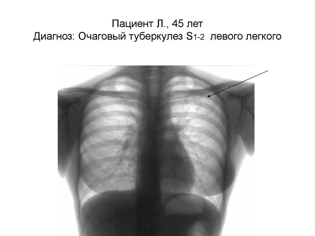 Очаговый туберкулез презентация