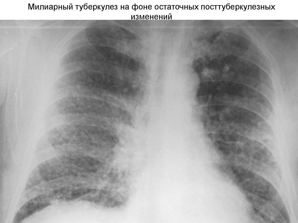 Милиарный туберкулез на фоне остаточных посттуберкулезных изменений