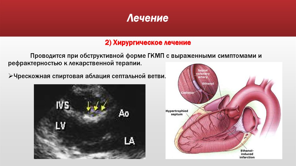 Миоэктомия. Хирургическое лечение гипертрофической кардиомиопатии. Операции при гипертрофической кардиомиопатии. ГКМП обструктивная форма.