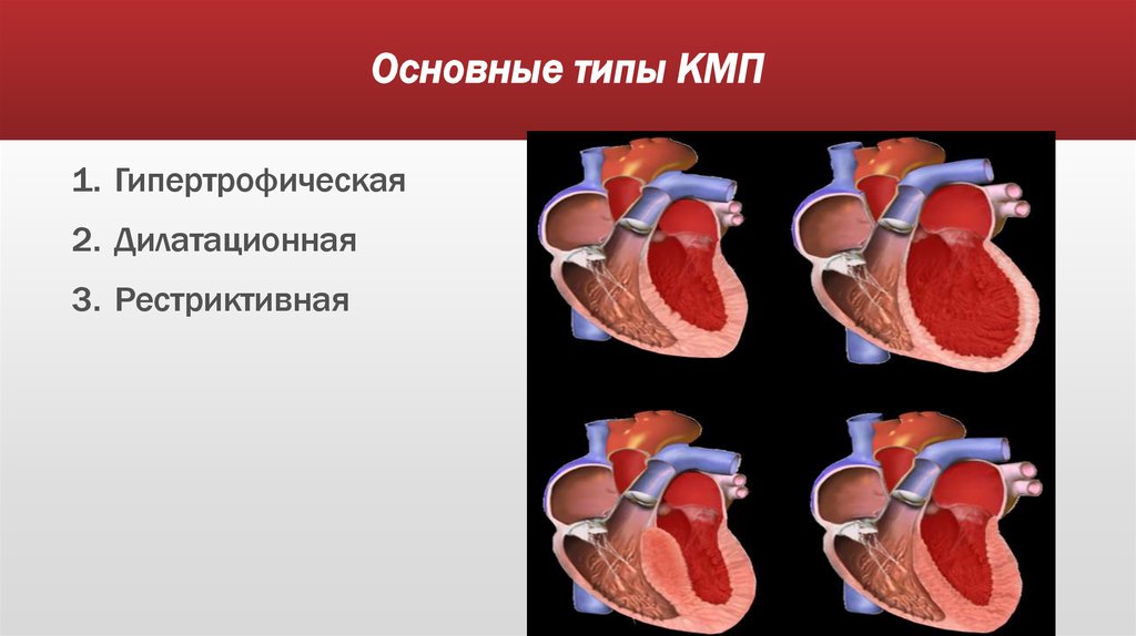 Дилатационная кардиомиопатия мкб