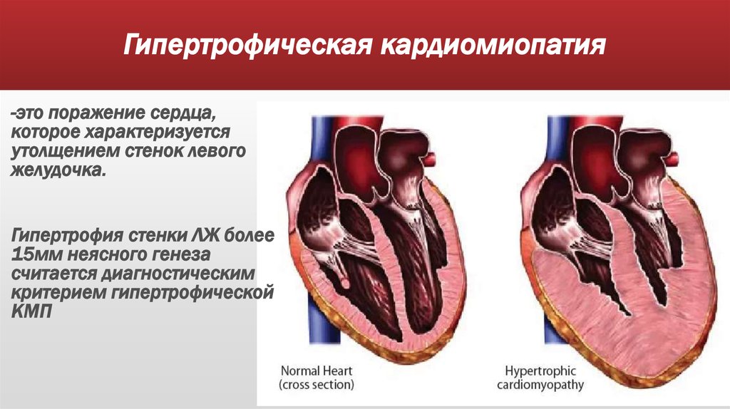 Кардиомиопатии у детей презентация