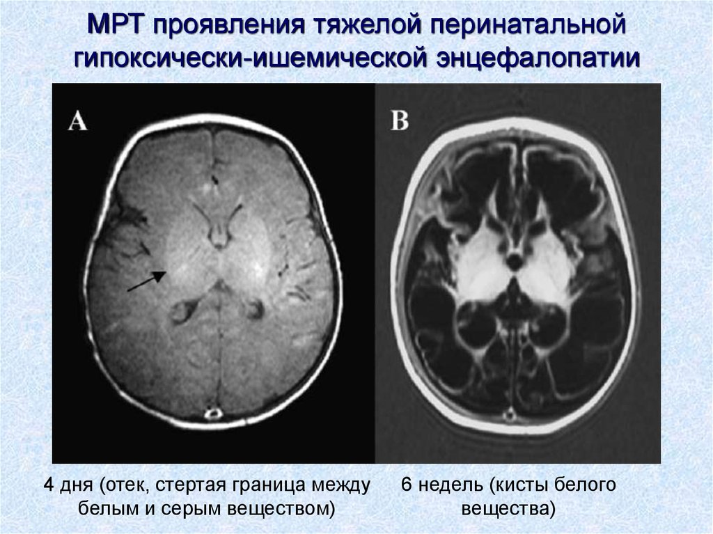 Постгипоксические изменения головного мозга. Гипоксически-ишемическая энцефалопатия кт. Гипоксически-ишемическое поражение головного мозга кт. Гипоксическая ишемическая энцефалопатия новорожденного. Гипоксическая энцефалопатия на мрт.