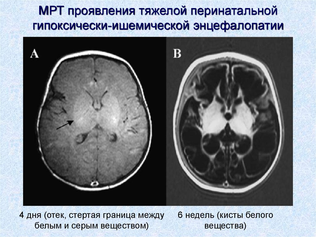 Гипоксические изменения мозга