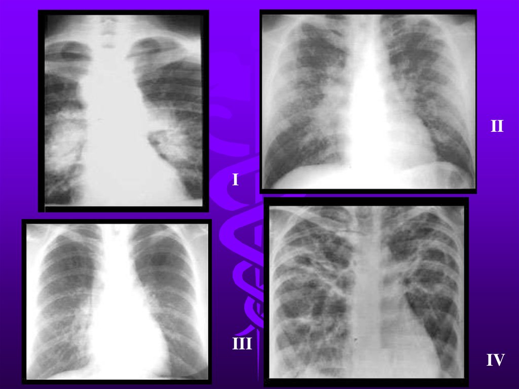 Поражением легких 50. Мелкоочаговая диссеминация кт. Диффузная пневмония рентген. Диссеминированные заболевания легких рентген. Мелкоочаговая диссеминация в легких что это.