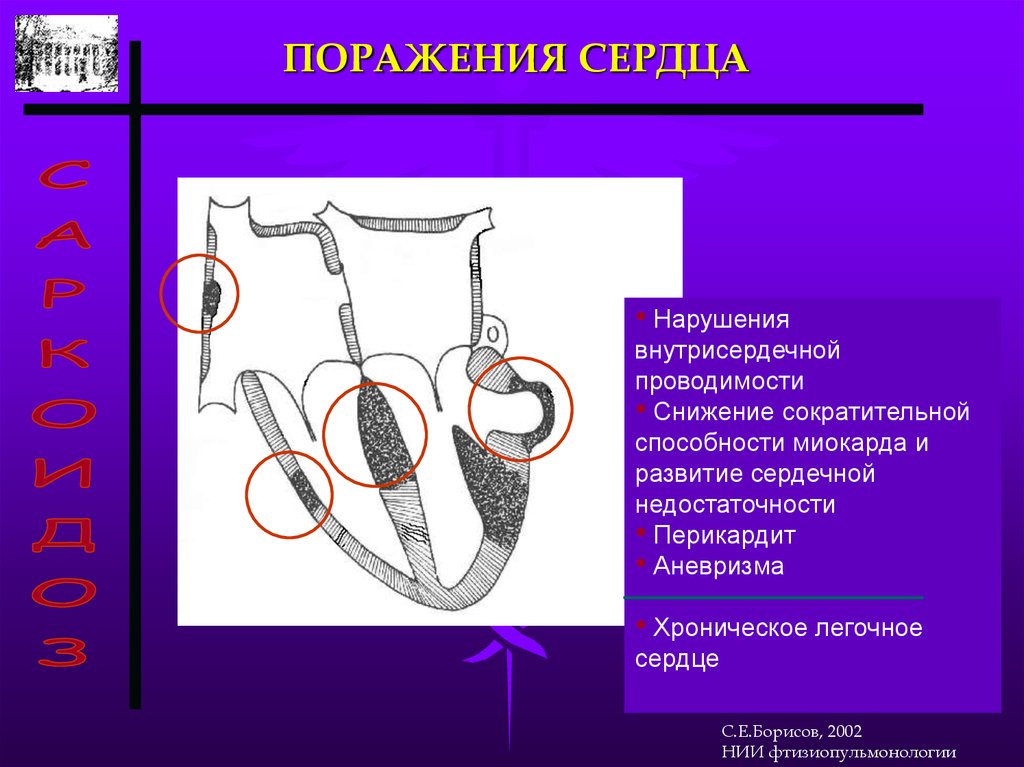 Снижение сократительной способности миокарда. Сократительная способность миокарда. Нарушение внутрисердечной проводимости.