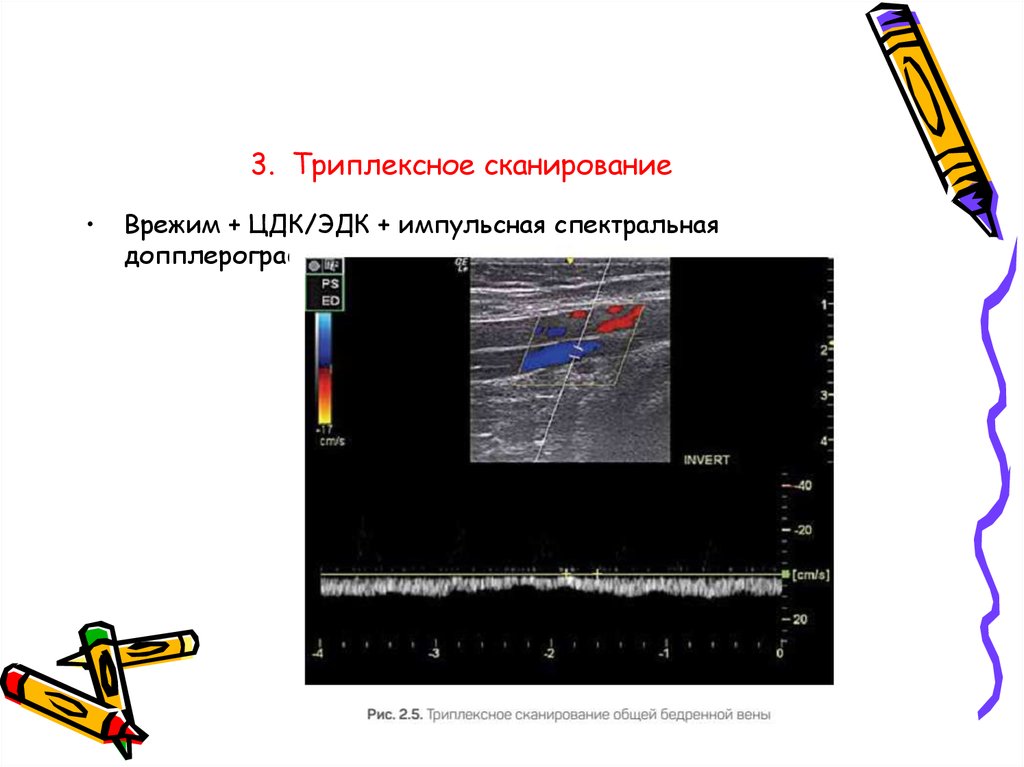 Что значит в режиме цдк. Дуплексное и триплексное сканирование сосудов разница. Импульсная спектральная допплерография. Цветовое допплеровское картирование. Триплексное сканирование.