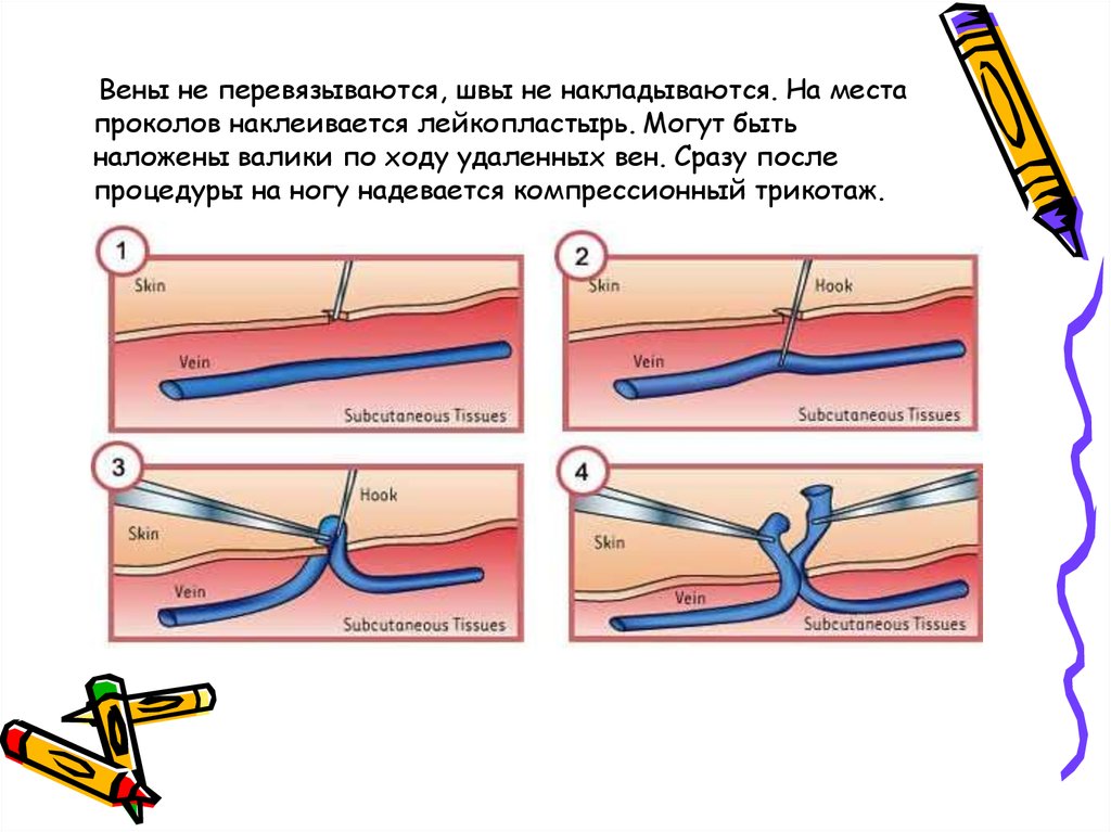 Узлы рассасывает