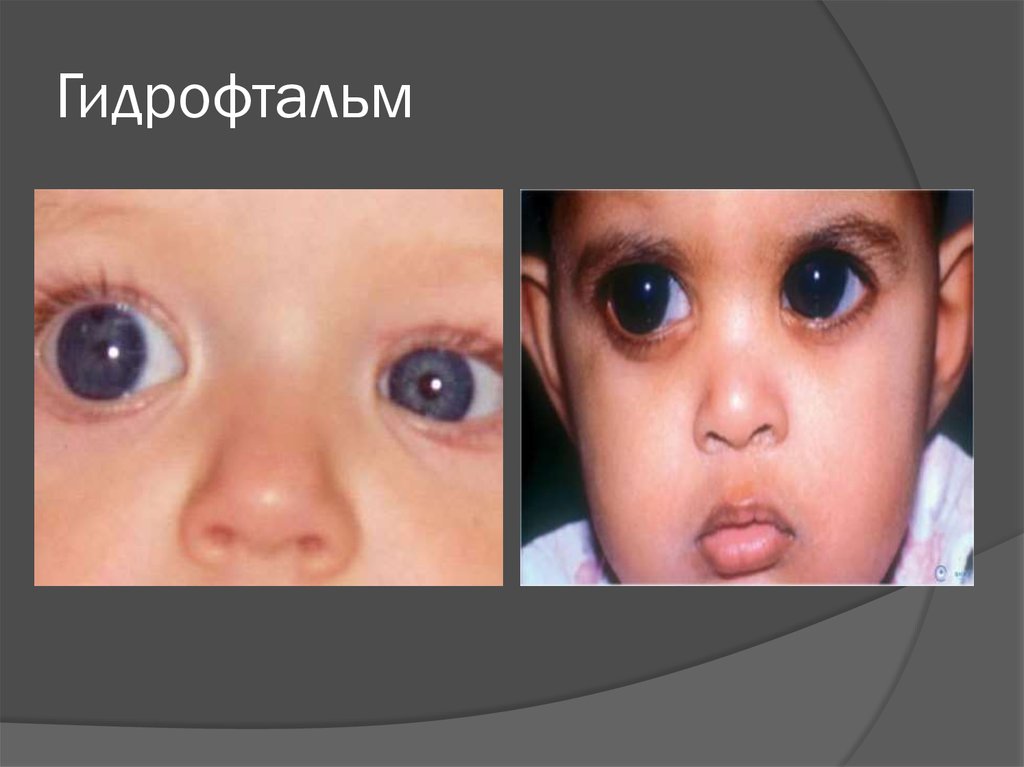 Гидрофтальм
