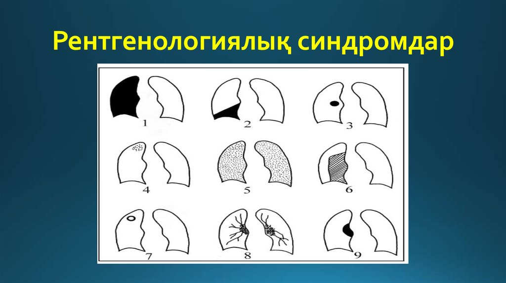 Рентгенологические синдромы легких. Рентгенологические легочные синдромы. Рентгенологические синдромы патологии легких. Основные рентгенологические синдромы заболеваний органов дыхания. Схемы рентгенологических синдромов заболеваний легких.