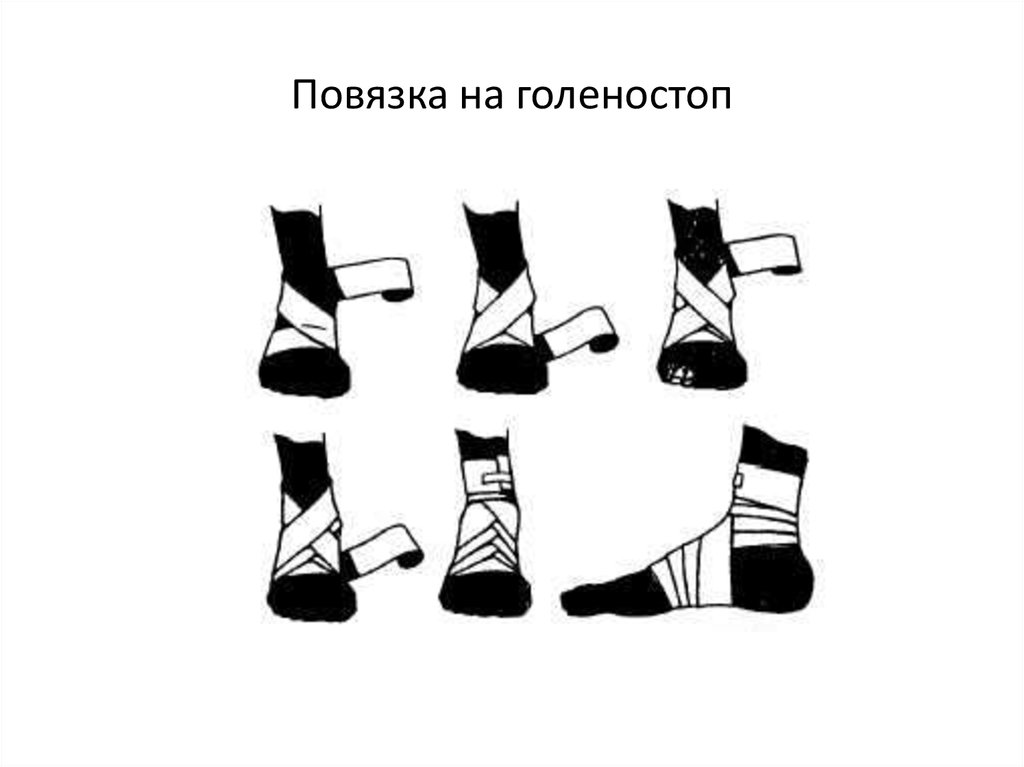 Как правильно наложить эластичный бинт на ногу. Правильное бинтование голеностопа эластичным бинтом. Забинтовать голеностоп эластичным бинтом. Схема бинтования лодыжки. Бинтование при растяжении стопы.