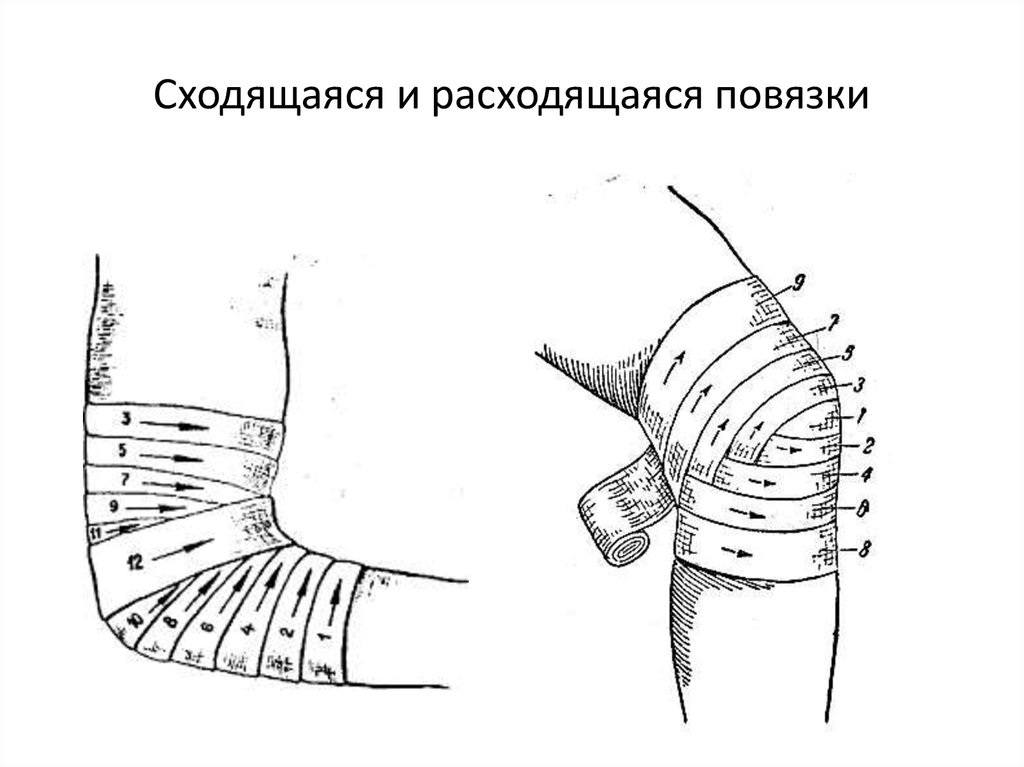 Черепашья расходящаяся повязка на коленный сустав. Черепашья сходящаяся на локтевой сустав повязка. Повязки на коленный сустав десмургия. Схема черепашья сходящаяся повязка.