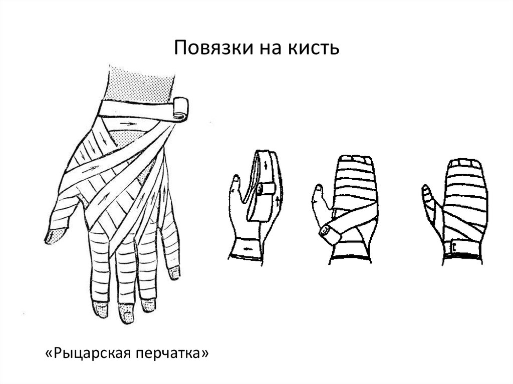 Бинтование. Бинтование Рыцарская перчатка. Повязка на кисть десмургия. Рыцарская перчатка десмургия. Рыцарская перчатка перевязка.