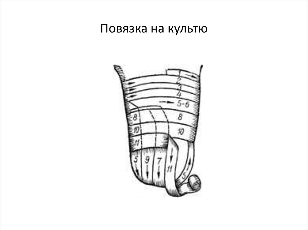 Повязка на культю алгоритм. Наложение возвращающейся повязки на культю. Наложение повязки на культю алгоритм. Продемонстрируйте технику наложения повязки на культю.. Возвращающая повязка на культю алгоритм.