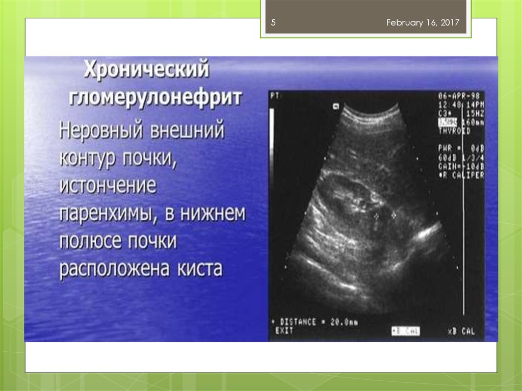 Узи признаки. Гломерулонефрит на УЗИ почек. Гломерулонефрит УЗИ картина. Хронический гломерулонефрит УЗИ. Хронический гломерулонефрит УЗИ почек.