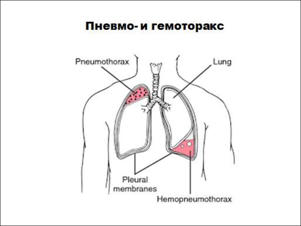 Объем гидроторакса. Пневмоторакс и гидроторакс. Пневмоторакс гидроторакс гемоторакс. Пневмоторакс и гемоторакс.