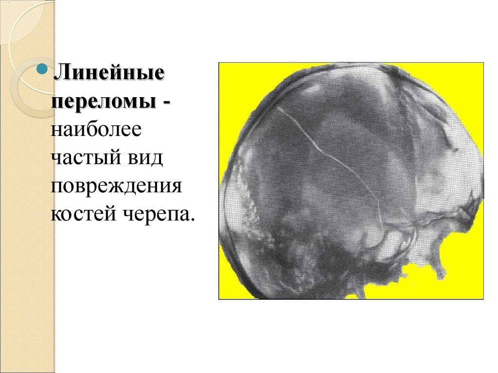 Линейный перелом свода черепа