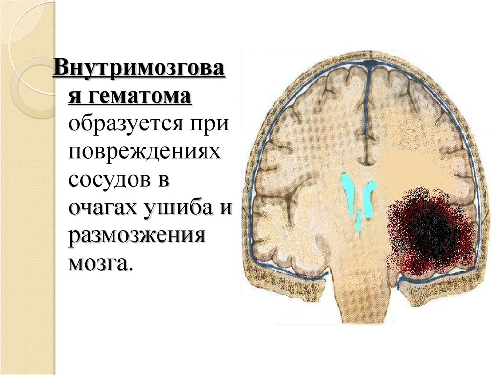 Органическое повреждение головного мозга. Гематома может образоваться при. Разрушение костей свода черепа.