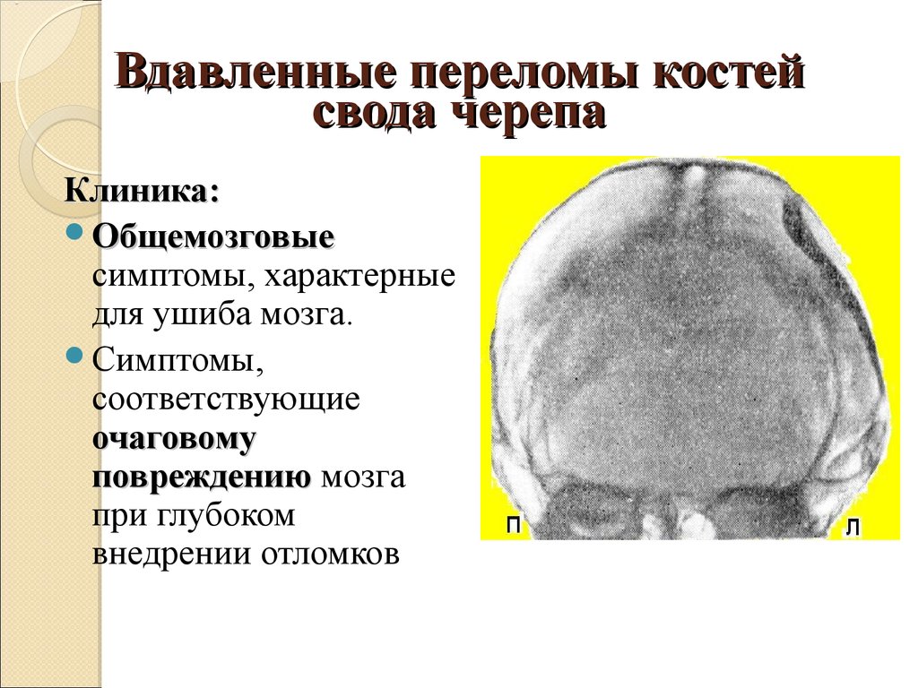 Признаки перелома свода черепа