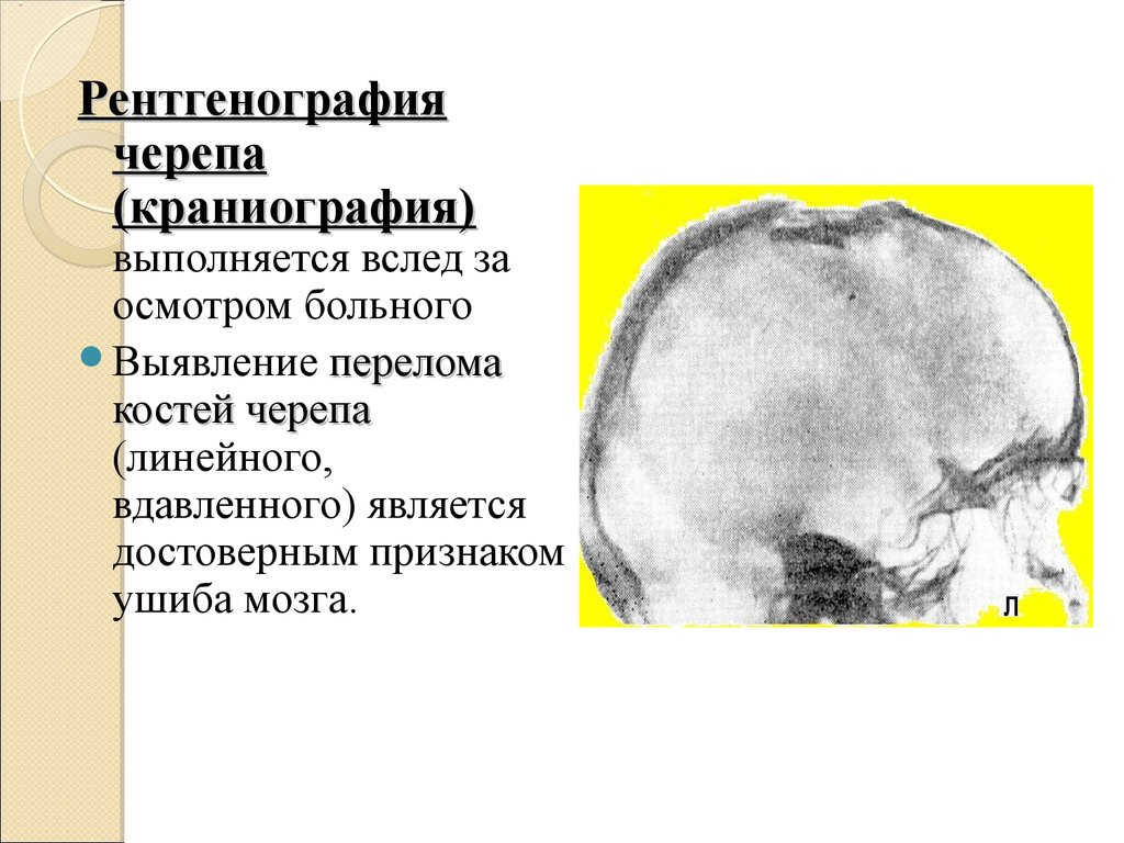 Травмы черепа и головного мозга. Перелом основания черепа неврология. Вдавленный перелом черепа. Рентгенограмма черепа (краниограмма);.