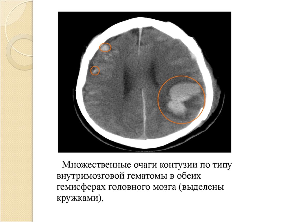 Очаг мозга. Контузионные очаги головного мозга на кт. Контузионный очаг 2 типа кт. Контузионный очаг головного мозга кт. Очаги ушиба головного мозга на кт.