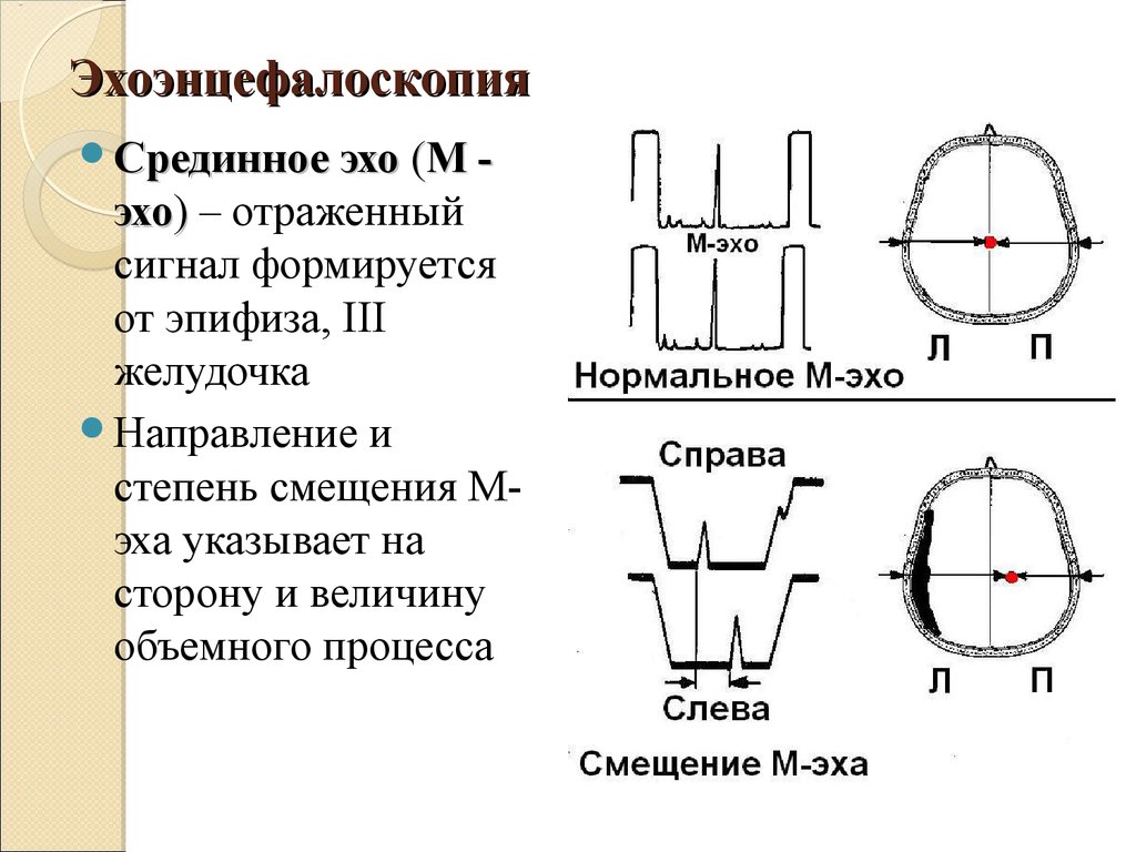 Сколько эхо. М-Эхо срединных структур головного мозга. Эхо головы нормы. М Эхо головы показатели для ребенка. Эхоэнцефалоскопия норма показателей.