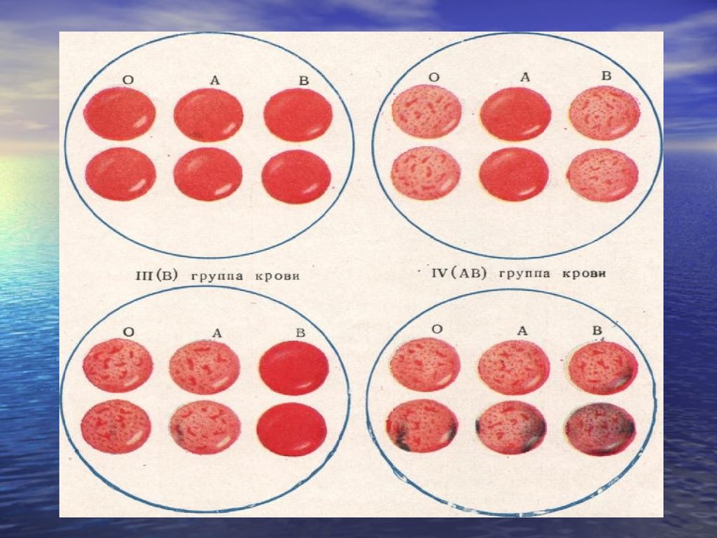 Группа крови 2013. Агглютинация 4 группы крови. Как определить 4 группу крови. Группы крови рисунок. Определить группу крови по рисунку.