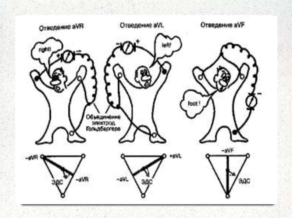 Снятие экг отведения. Схема расположения отведений по Эйнтховену. Треугольник расположения электродов. ЭКГ расположение электродов. Стандартные отведения по Эйнтховену относятся.