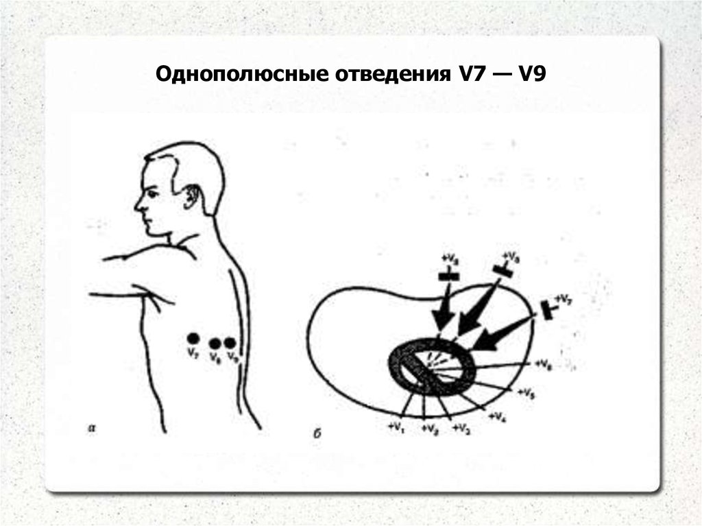 Кардиоджет инструкция по применению схема наложения электродов