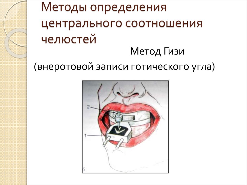 Определение центрального соотношения челюстей при полном отсутствии зубов презентация