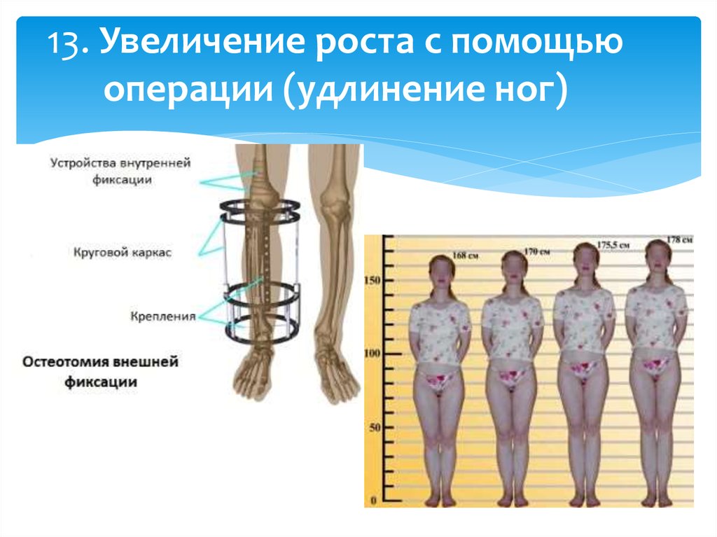 На сколько можно удлинить. Аппарат Илизарова для удлинения. Операция по удлиннениюконесностей. Удлинение ног операция.