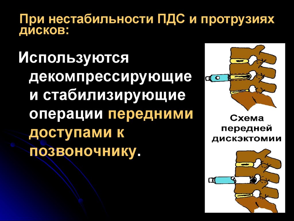 Нестабильность отдела позвоночника. Нестабильность ПДС. Нестабильность позвоночно-двигательного сегмента. Остеохондроз позвоночно-двигательного сегмента. Стабилизирующие операции на позвоночнике при остеохондрозе.